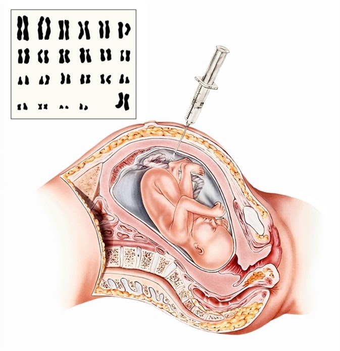 Amniocentesis Op.dr. Nezih Durmazlar Kad n Hastal klar ve